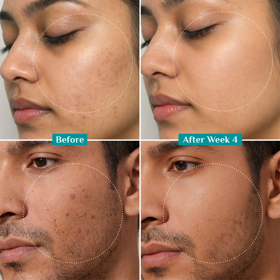 10% Niacinamide Face Serum With 1% Zinc PCA